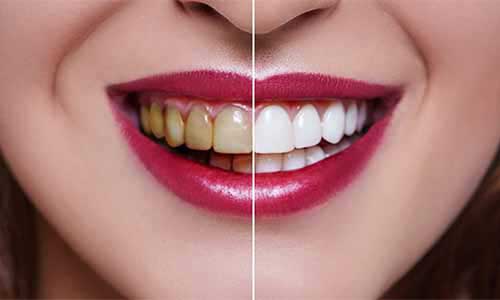 Braces and Aligners Rohini
